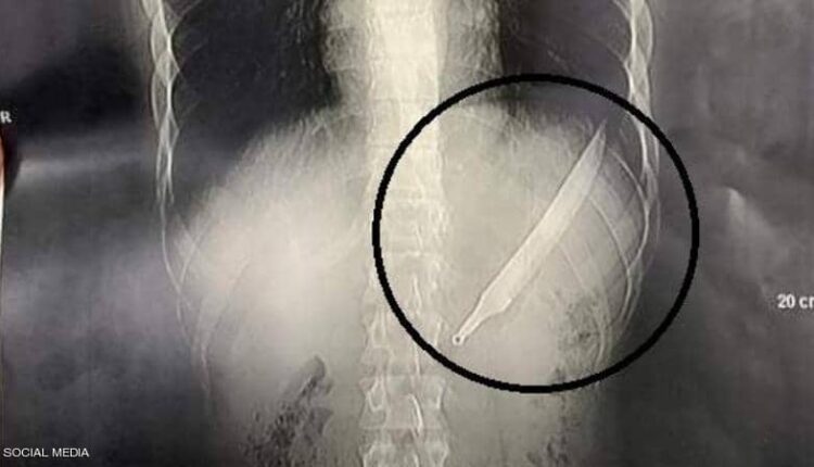 شاب مصري يبتلع سكين